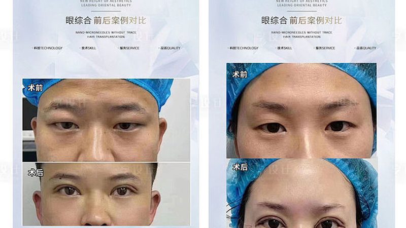 全切双眼皮消肿：揭秘恢复过程与时间