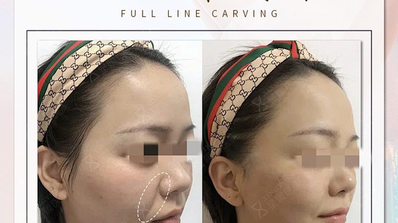 面部埋线提升，揭秘价格背后的秘密