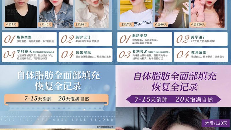 上海肉毒素注射，揭秘专业流程与注意事项**