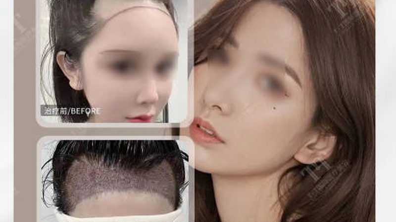 肉毒素玻尿酸厂家直销价：你被“底价”骗过吗