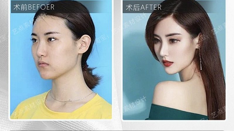 广州光子嫩肤团购哪个牌子仪器好