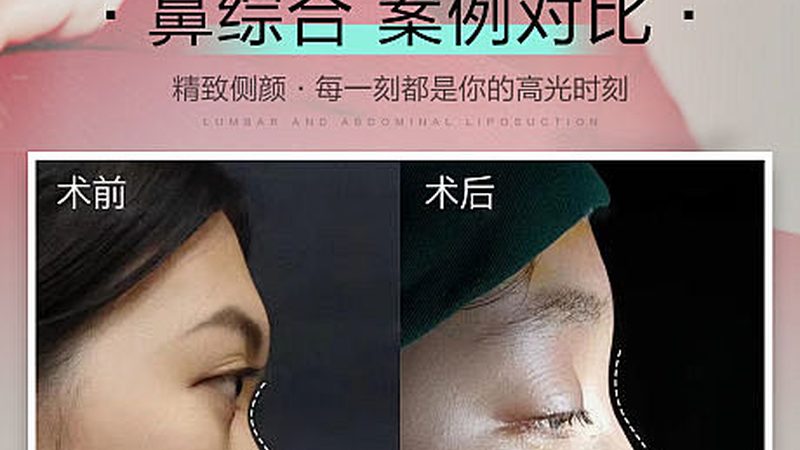 瘦肩针肉毒素：揭秘其原理与品牌选择要点