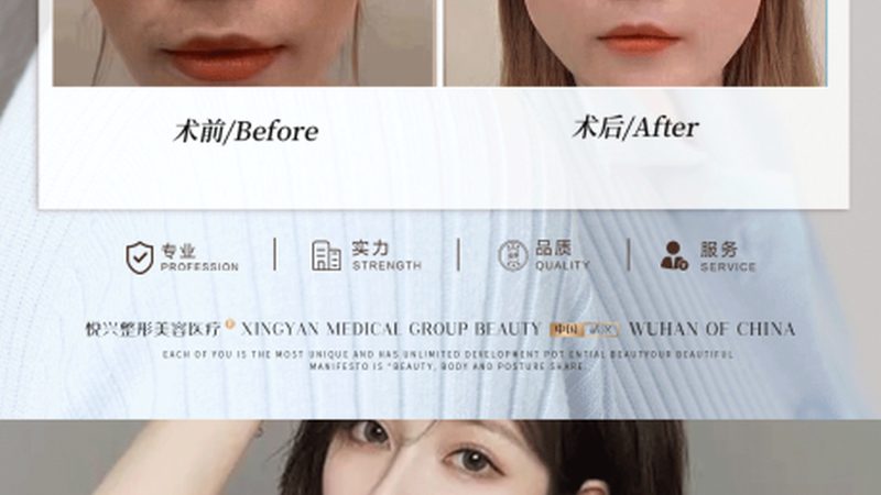 黄褐斑治疗新选择：激光与刷酸，如何抉择？**