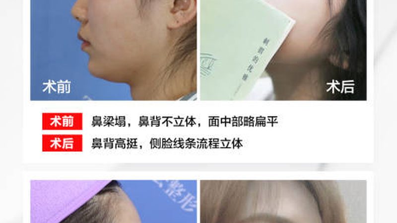 玻尿酸填充为何维持时间短？揭秘背后的原因**