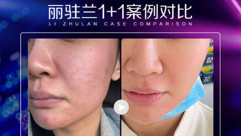 家用脱毛仪如何选？揭秘与医用效果更近的距离