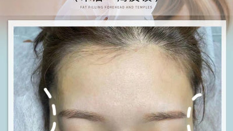 激光美容仪器，如何挑选优质直销产品？**