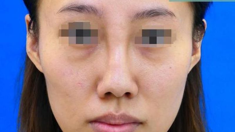 医美术后，这些注意事项你了解吗？**